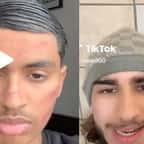 Cicatrice Challenge : les dermatologues mettent en garde contre ce défi dangereux sur TikTok 
