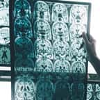 Des chercheurs découvrent un nouveau traitement possible pour agir contre la maladie d'Alzheimer 
