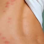 Mais pourquoi les moustiques s'acharnent toujours sur les mêmes personnes ? On a enfin la réponse