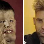 Mitchell Hunter avant et après sa greffe totale du visage 