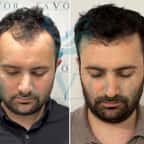 un exemple de greffe de cheveux chez Este Favor