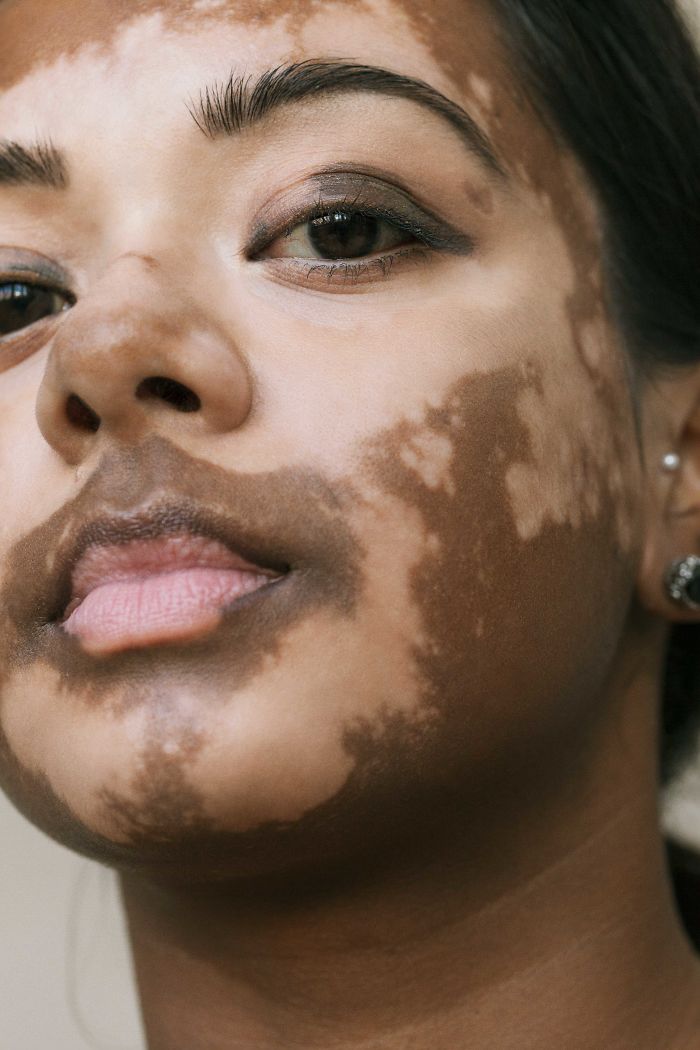 Le Vitiligo Mis En Lumière Par Une Photographe Elle Même Atteinte Lors