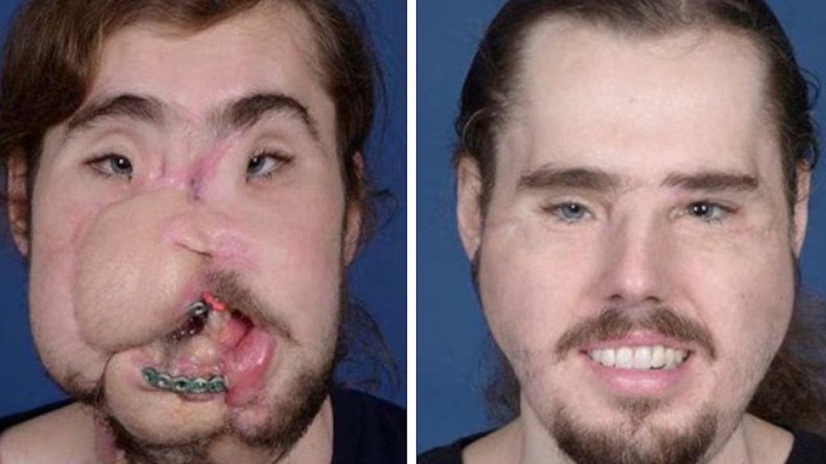 Défiguré, une greffe spectaculaire lui redonne un visage et une nouvelle chance dans la vie