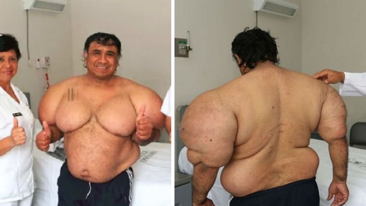 «Les gens n'arrêtent pas de me regarder» : son corps a gonflé après un accident de plongée, il vit depuis un calvaire