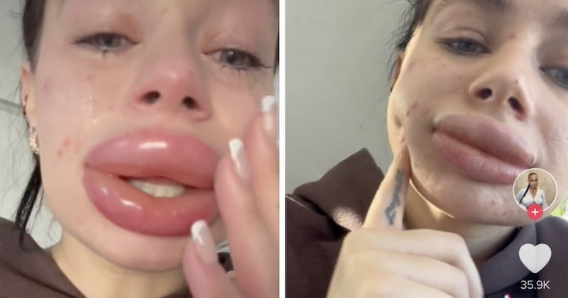 Une influenceuse finit défigurée après une opération des lèvres qui se transforme en cauchemar