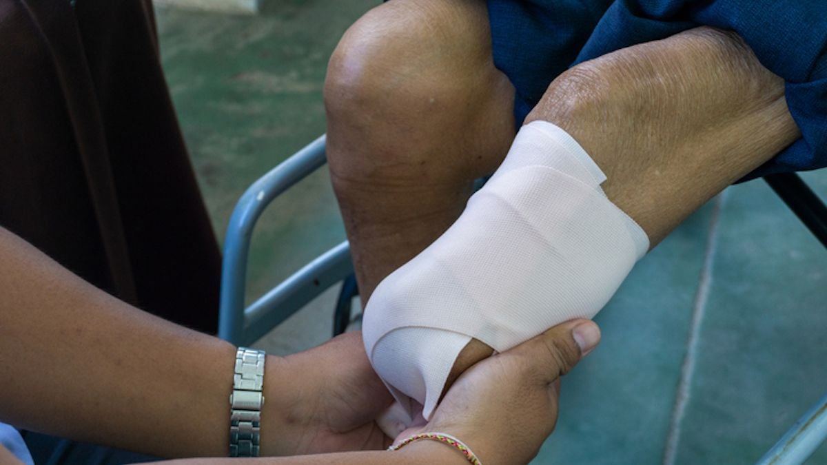Pour escroquer son assurance de 530 000 €, il va jusqu'a... se faire amputer les jambes 