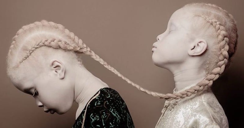 Leur beauté délicate et rare est en train de créer un véritable raz-de-marée : atteintes d'albinisme, ces jumelles Brésiliennes sont promises à un avenir radieux ! 