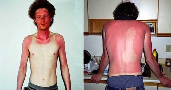 18 images qui prouvent qu'il ne faut jamais bronzer sans crème solaire... Ces coups de soleil sont incroyables !