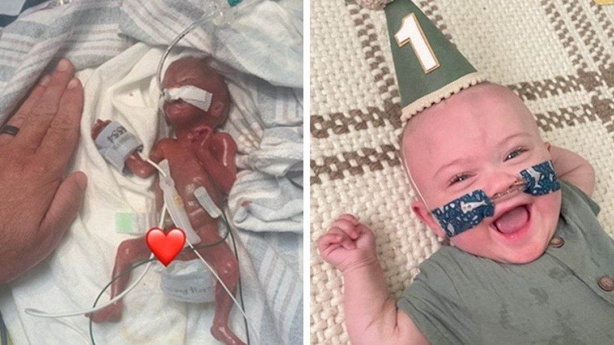 Né à 21 semaines, ce bébé prématuré qui avait peu de chance de survie a fêté son 1er anniversaire