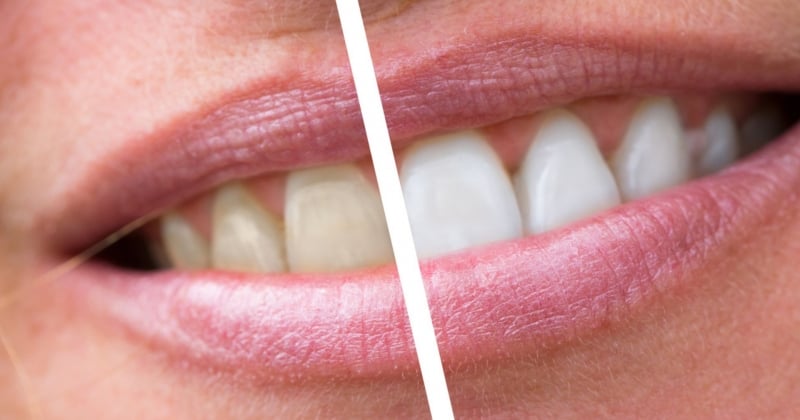 Les 5 astuces magiques pour avoir des dents plus blanches