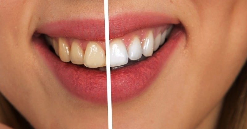 10 aliments qui jaunissent les dents