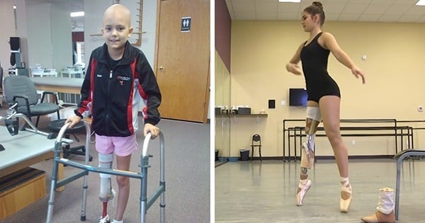 Gabi, la jeune danseuse amputée à cause d'un cancer infantile, peut désormais participer à des compétitions de danse grâce à une chirurgie très spéciale...