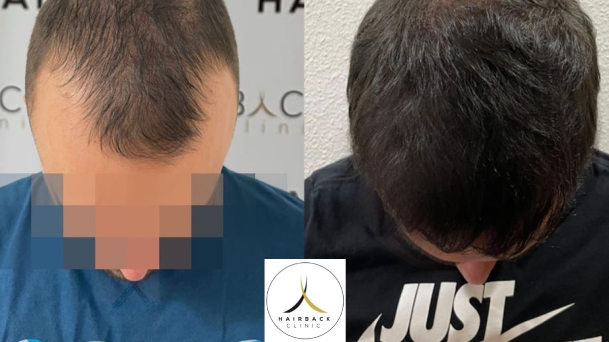 Destination de choix pour la greffe de cheveux en Turquie, à la découverte de HairBack Clinic