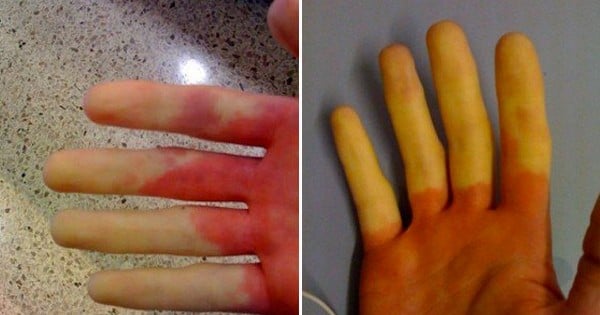 15 choses que seuls ceux qui ont la maladie de Raynaud comprendront !