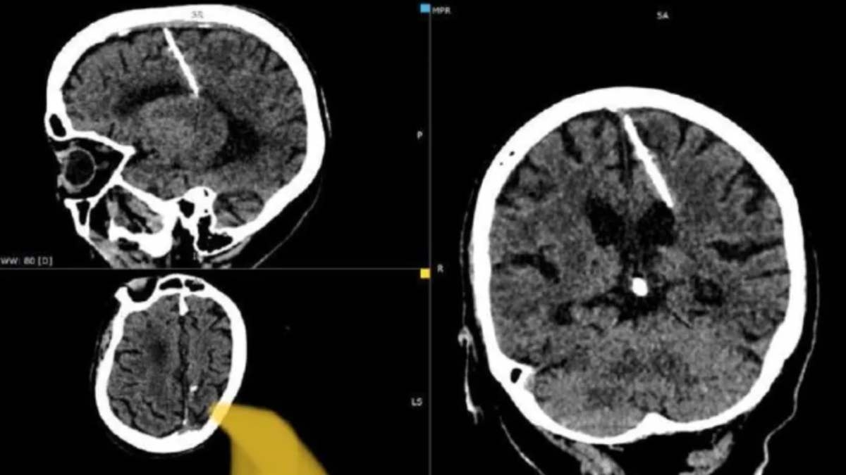 Elle se présente pour une radio, les docteurs découvrent un objet terrifiant planté dans son cerveau