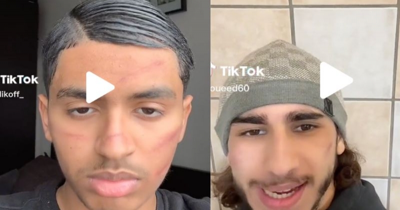 Les dermatologues mettent en garde les jeunes contre ce défi dangereux de TikTok