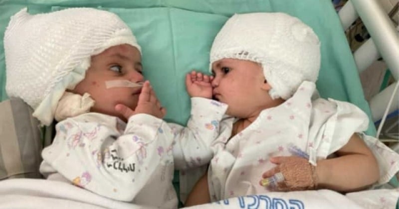 Ces sœurs siamoises reliées par la tête se découvrent pour la première fois après leur opération