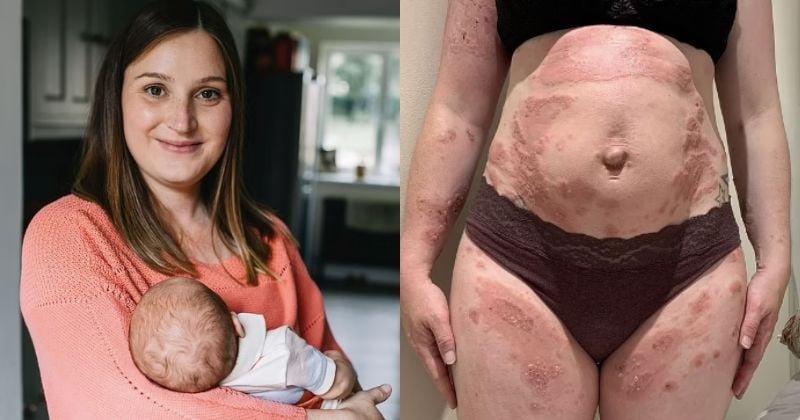 Enceinte, cette jeune femme découvre qu'elle est allergique au...bébé qu'elle porte