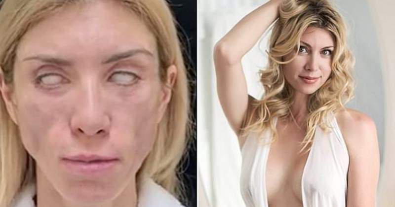 Suite à une chirurgie ratée, cette ancienne reine de beauté ne peut plus fermer les yeux ni sourire