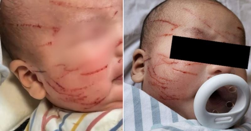 Cette maman découvre avec horreur le visage de son bébé recouvert de griffures à la sortie de la crèche