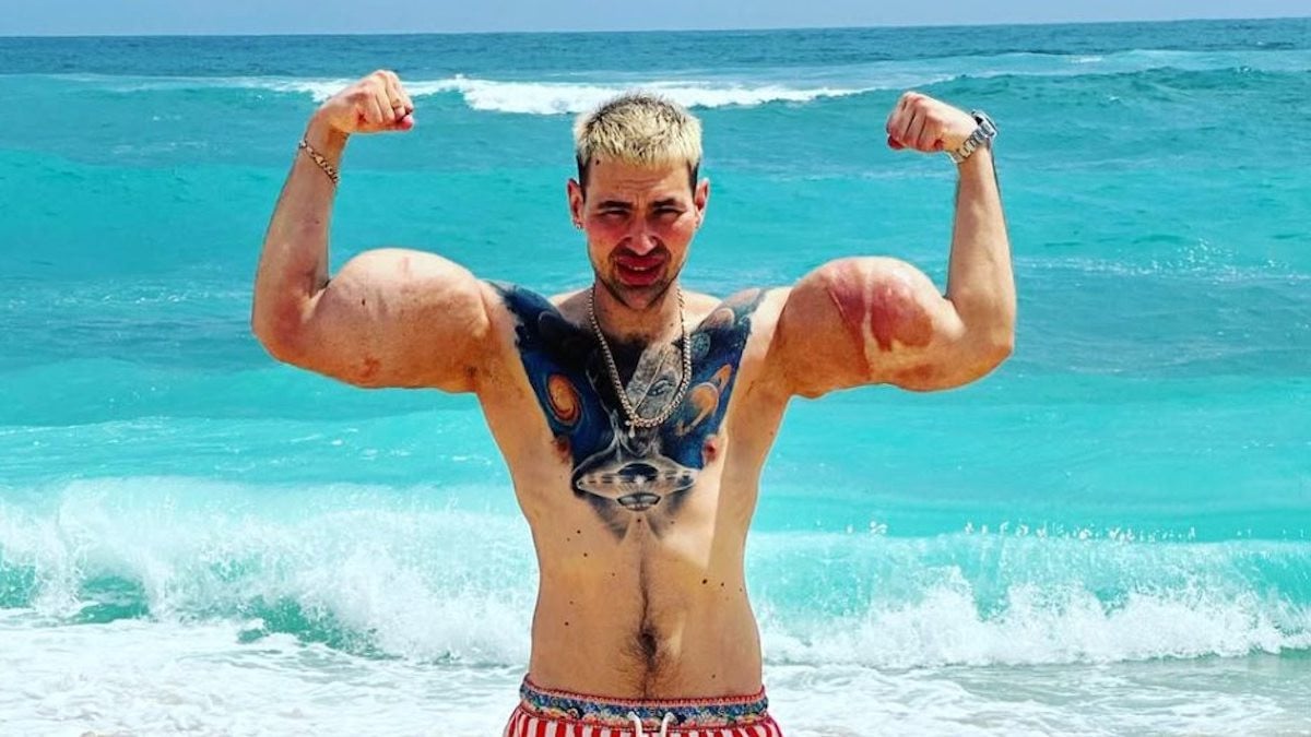 Le « Popeye Russe », qui s'est injecté des litres de synthol pour avoir des gros bras... pourrait les perdre