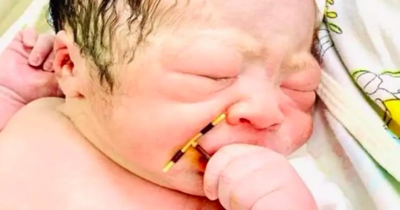 Les photos de ce bébé, né avec le stérilet de sa mère dans la main, sont devenus virales