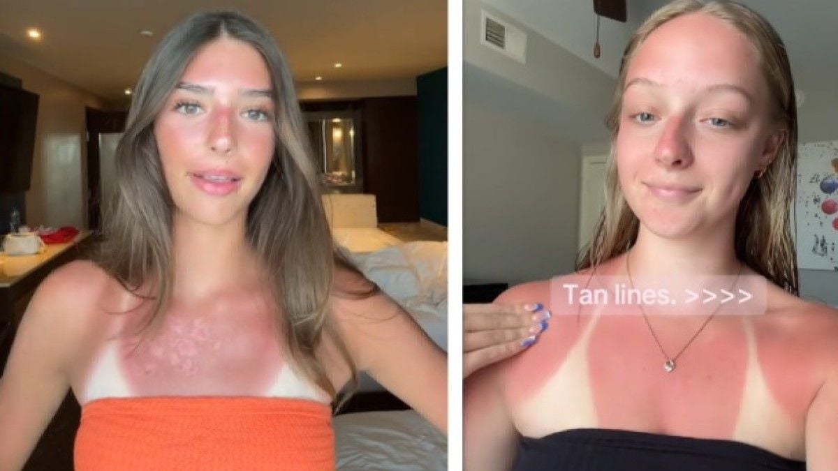 «Burn lines» : quelle est cette nouvelle tendance TikTok inquiétante et très dangereuse ?