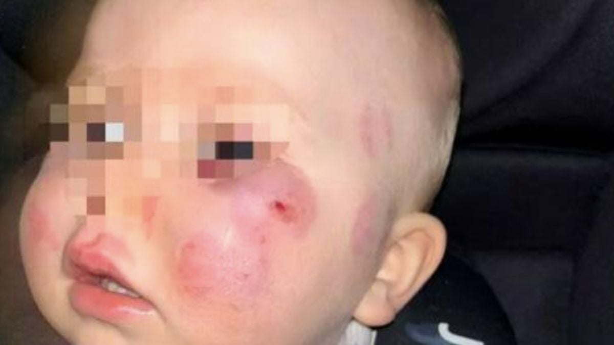 « Complètement défiguré » : choquée, elle récupère son bébé à la crèche avec de graves morsures au visage