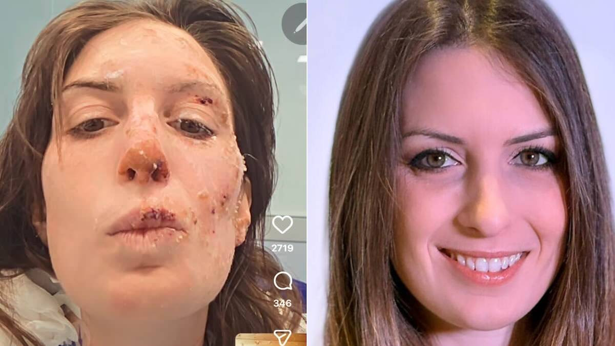 Défigurée, une victime de l'incendie de Crans-Montana montre ses brûlures pour la première fois et livre un message émouvant