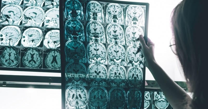Des chercheurs découvrent un nouveau traitement possible pour agir contre la maladie d'Alzheimer 
