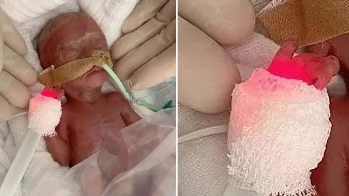 Né à 5 mois de grossesse, ce bébé prématuré pesait seulement... 300 grammes