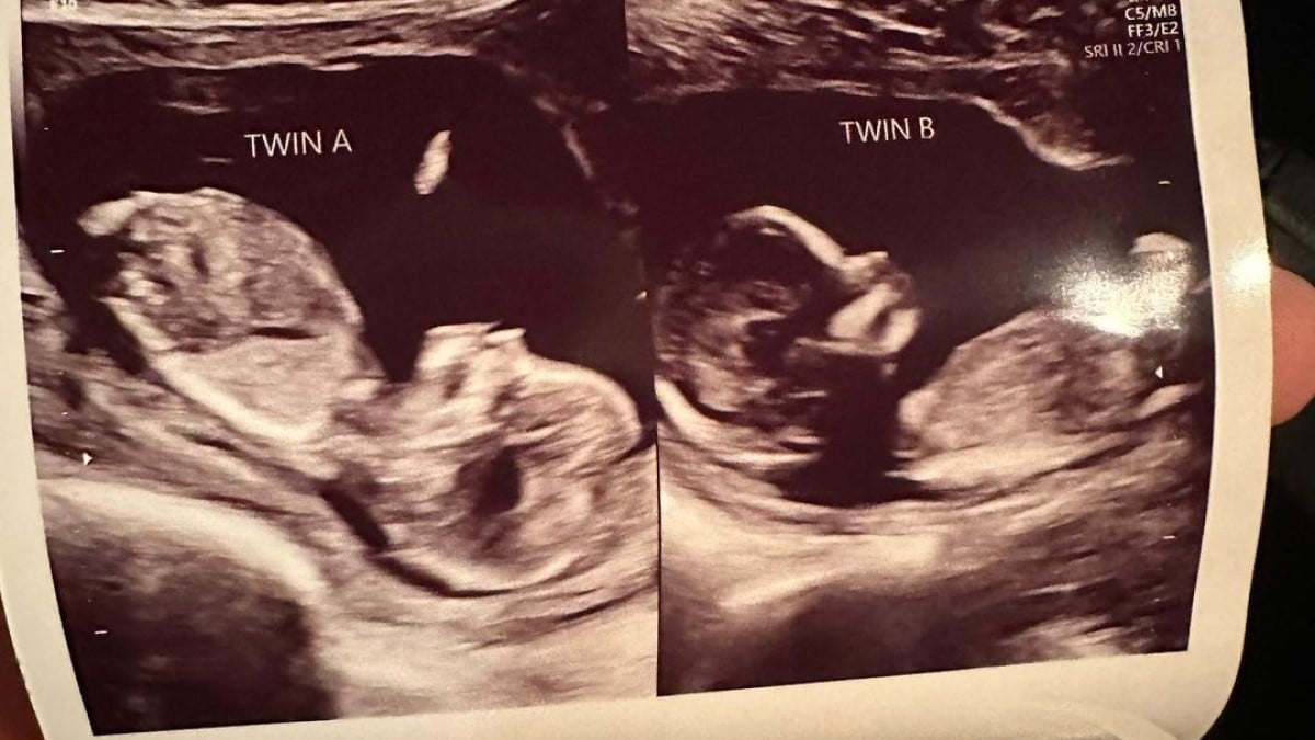 Née avec deux utérus, cette femme va accoucher de deux bébés qui grandissent dans chacun d'eux