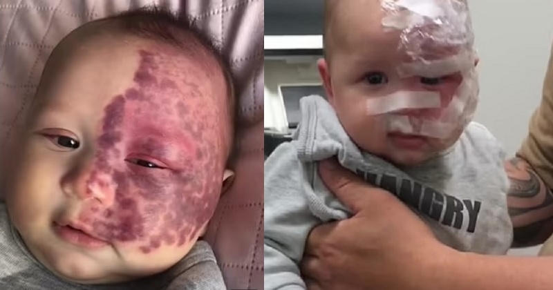 	Après avoir fait retirer la tache de naissance de son bébé au laser, cette maman se fait insulter par des internautes en colère