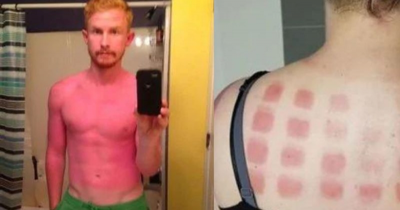 Ces vacanciers partagent des photos de leurs pires coups de soleil !