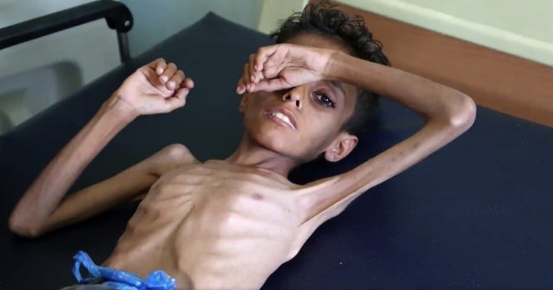 Yémen : près de 85 000 enfants seraient morts de faim ou de maladies depuis avril 2015