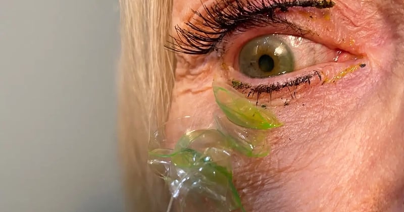 En Californie, une ophtalmologue a retiré 23 lentilles de contact de l'œil d'une septuagénaire