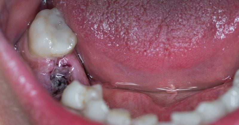 Incapable de trouver un dentiste près de chez lui, il prend une décision radicale