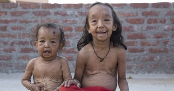 L'histoire de ces deux jeunes enfants Indiens ressemblant étrangement à « Benjamin Button » va vous bouleverser