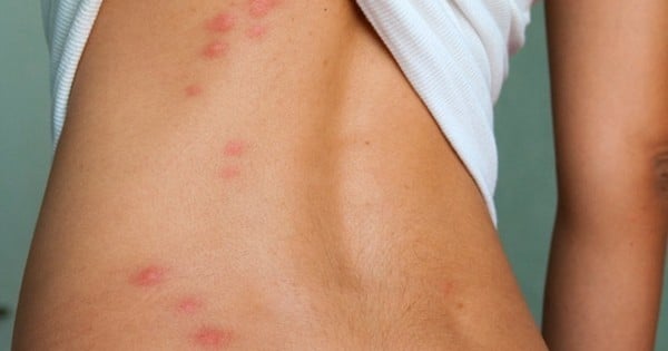 Mais pourquoi les moustiques s'acharnent toujours sur les mêmes personnes ? On a enfin la réponse