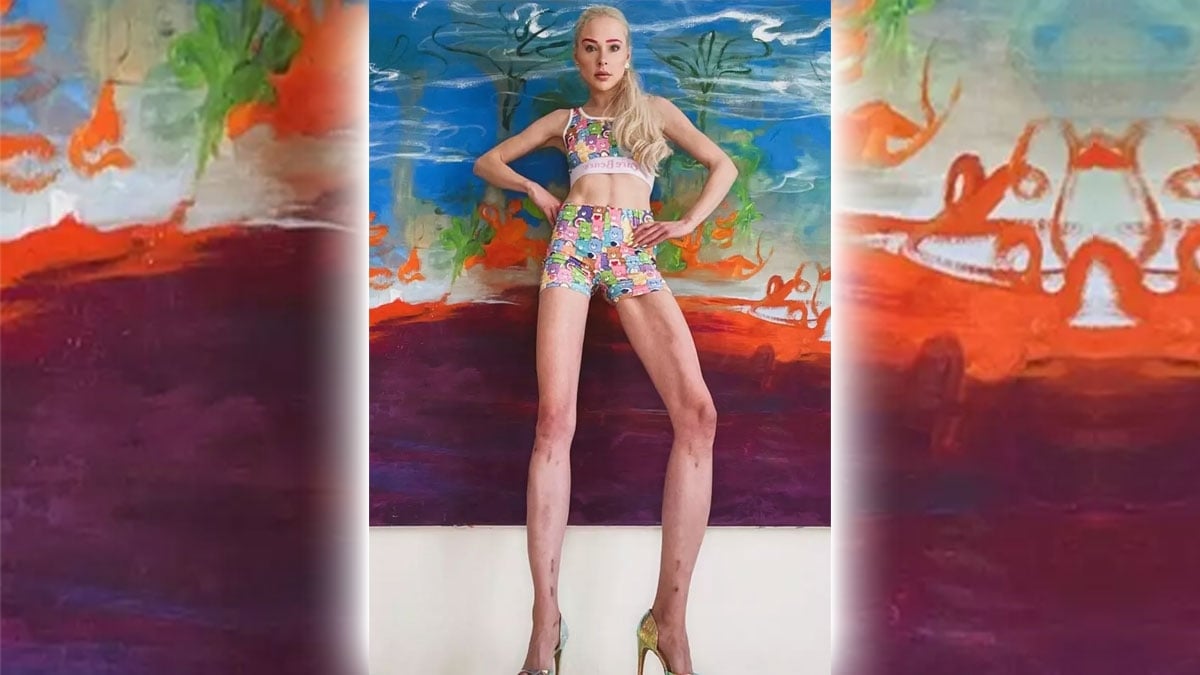 Après s'être fait manipuler, une mannequin dépense 150 000 euros pour agrandir ses jambes de 14 cm...