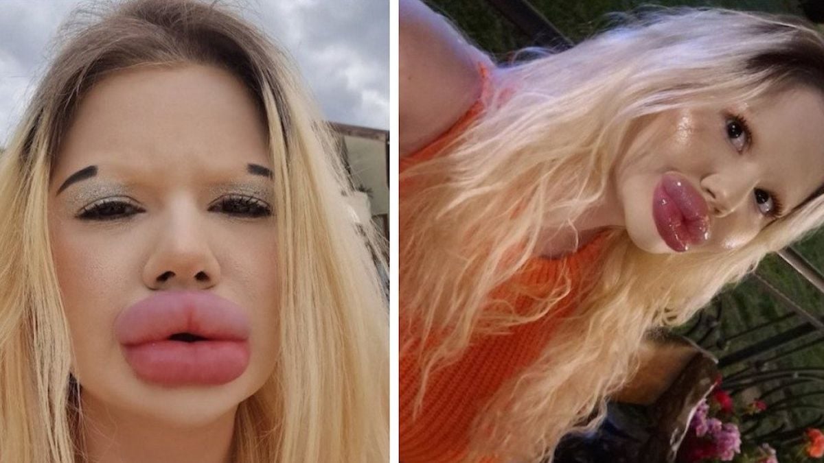 Voici à quoi ressemblait la femme aux plus grosses lèvres du monde avant ses injections	