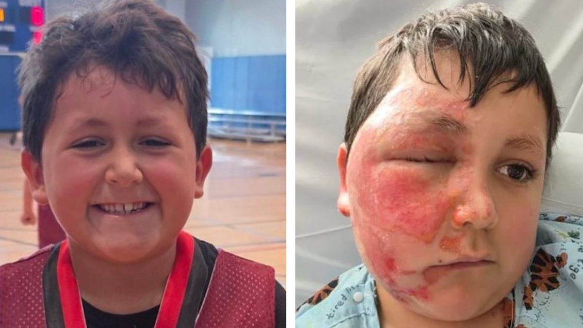 Un garçon de 9 ans se fait « fondre » le visage après avoir suivi une tendance TikTok inquiétante