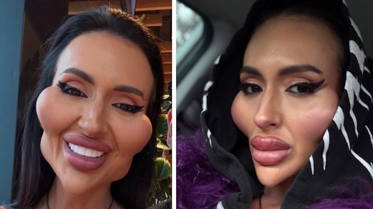 La femme avec les plus grosses joues du monde dévoile une photo d'elle avant ses opérations et choque la toile 