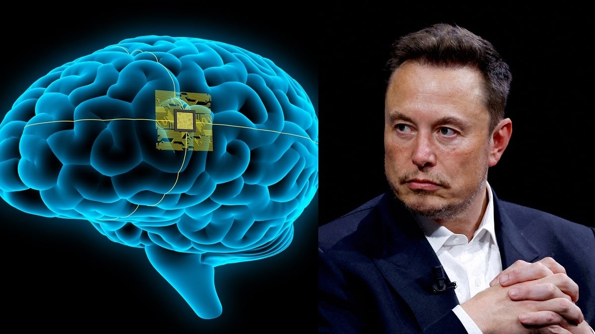 Un implant cérébral posé sur un patient pour la première fois par Neuralink, la start-up d'Elon Musk