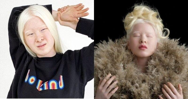 Abandonnée à sa naissance en raison de son albinisme, elle est aujourd'hui mannequin pour Vogue