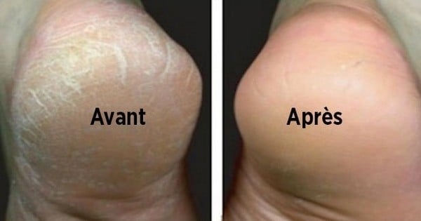 Pour enlever efficacement la corne de vos pieds, voici 3 remèdes de grand-mère