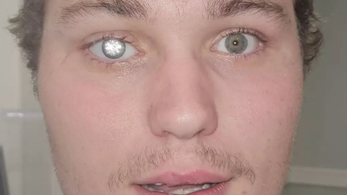 Il se fait greffer un diamant à deux millions de dollars dans l'oeil et fait sensation sur les réseaux sociaux