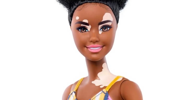 Pour stimuler la diversité, Mattel lance de nouvelles poupées Barbie vitiligo et sans cheveux	