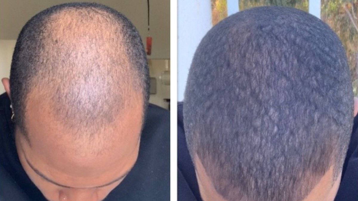 Ce produit miracle fait repousser les cheveux des hommes, les coiffeurs sont choqués