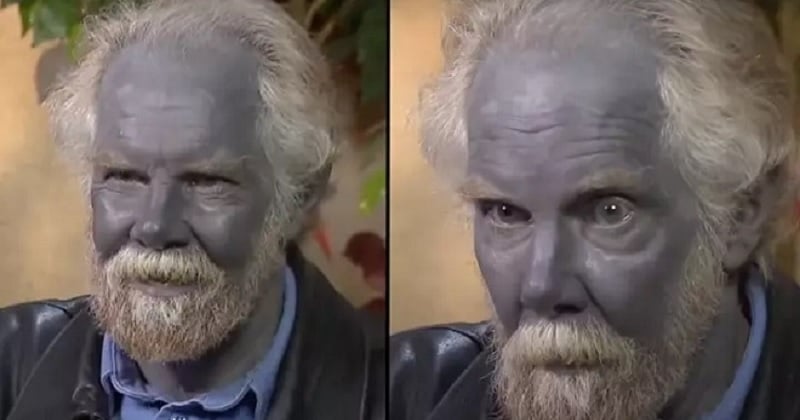 Cet homme est devenu bleu après avoir consommé des compléments alimentaires durant une décennie